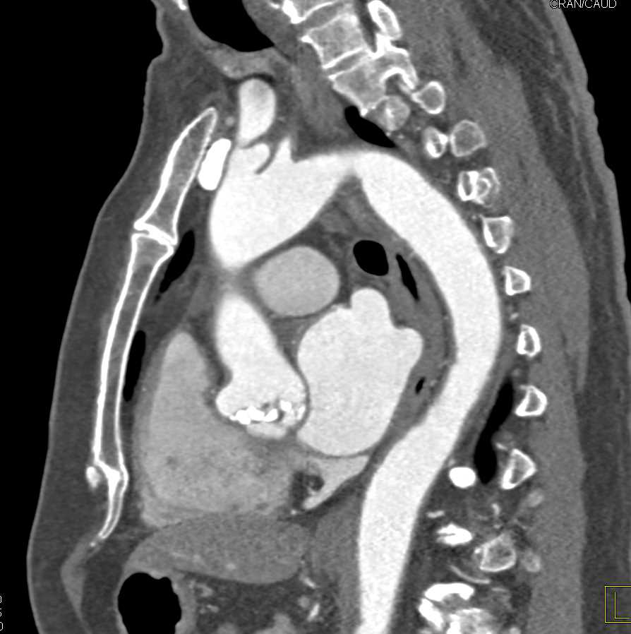 Bicuspid valve with Extensive Calcification and Aortic Stenosis - CTisus CT Scan