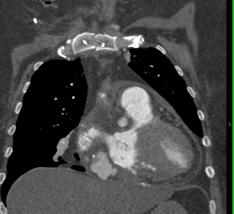 Cardiomyopathy - CTisus CT Scan
