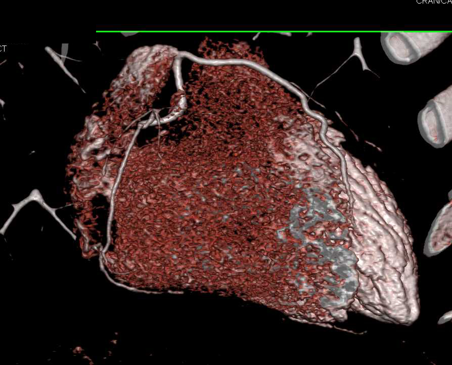 CCTA: Duplicated Left Anterior Descending Coronary Artery (LAD) Arising off Right Coronary Artery (RCA) and Tracking Anteriorly - CTisus CT Scan