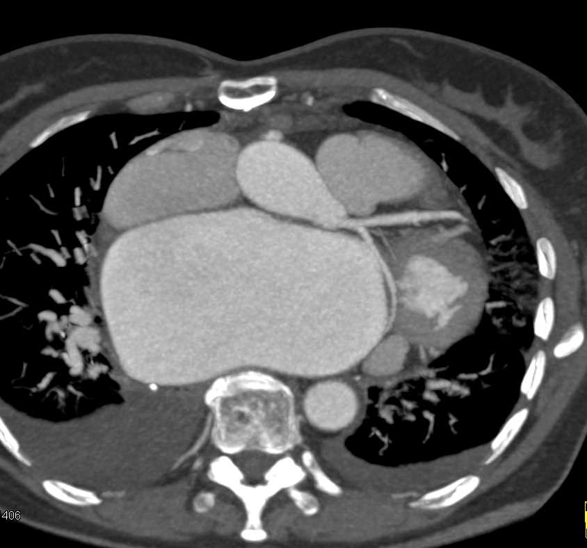 Markedly Dilated Left Atrium with Replaced MVR - CTisus CT Scan