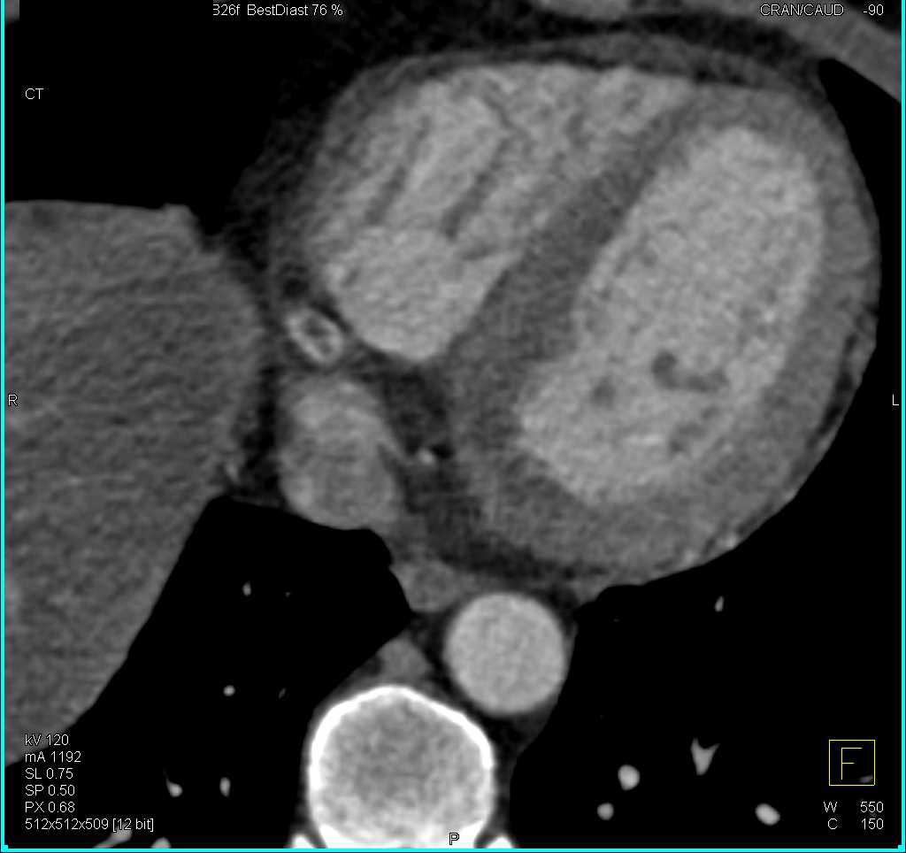 Clot in the Right Coronary Artery - CTisus CT Scan