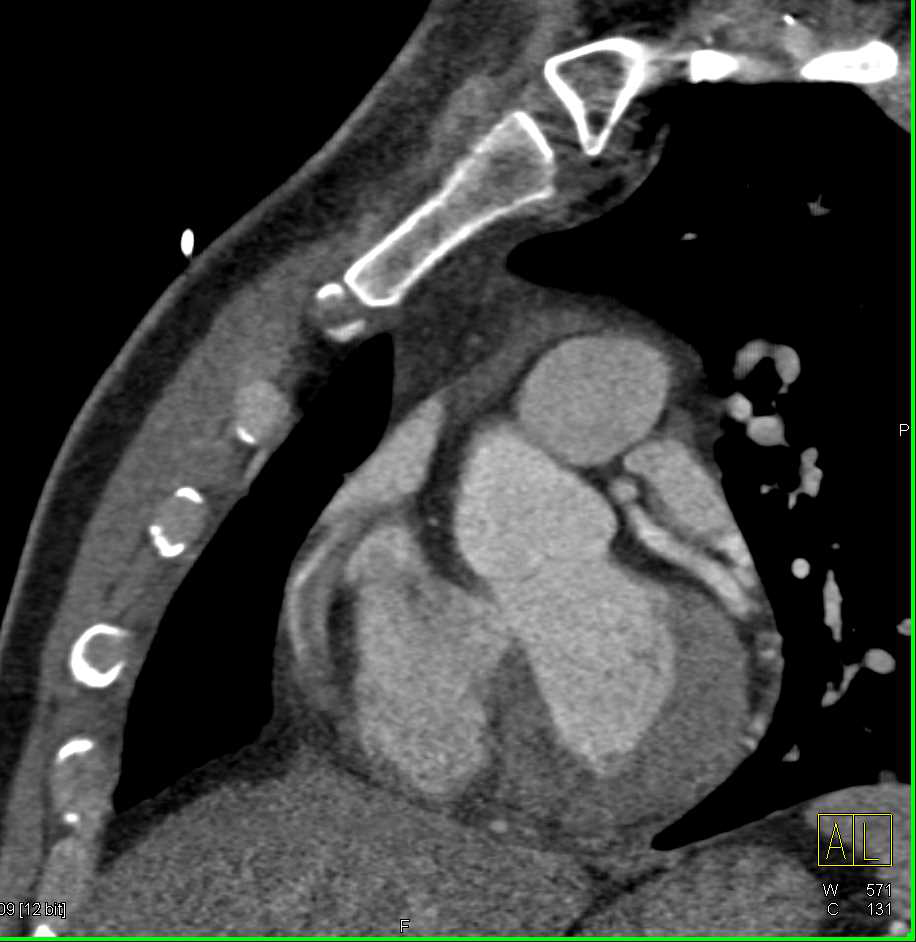 Clot in the Right Coronary Artery without Occlusion - CTisus CT Scan