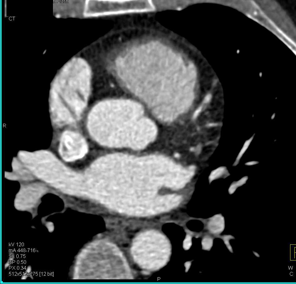 CCTA: Left Anterior Descending Coronary Artery (LAD) Plaque with Stenosis - CTisus CT Scan