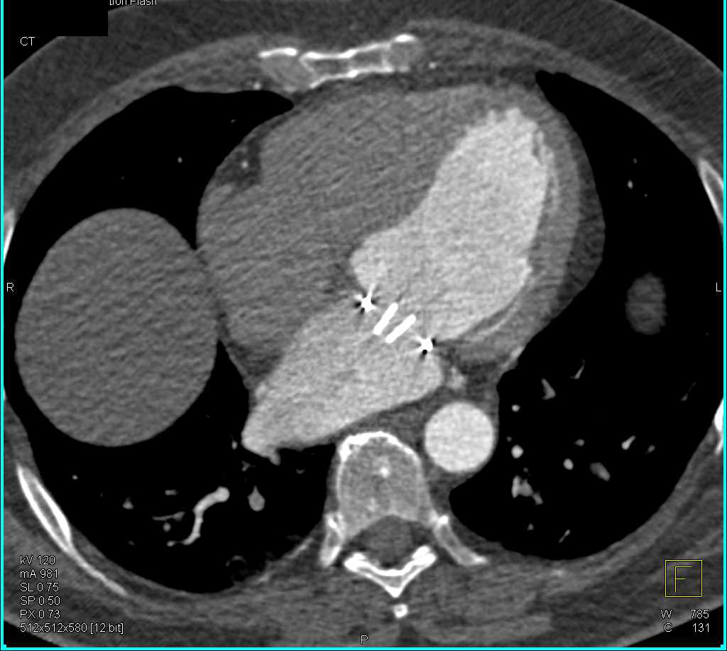 3D of Aortic Valve and Mitral Valve - CTisus CT Scan