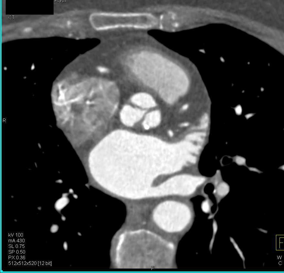 Aortic Valve Stenosis and Dilated Ascending Aorta - CTisus CT Scan