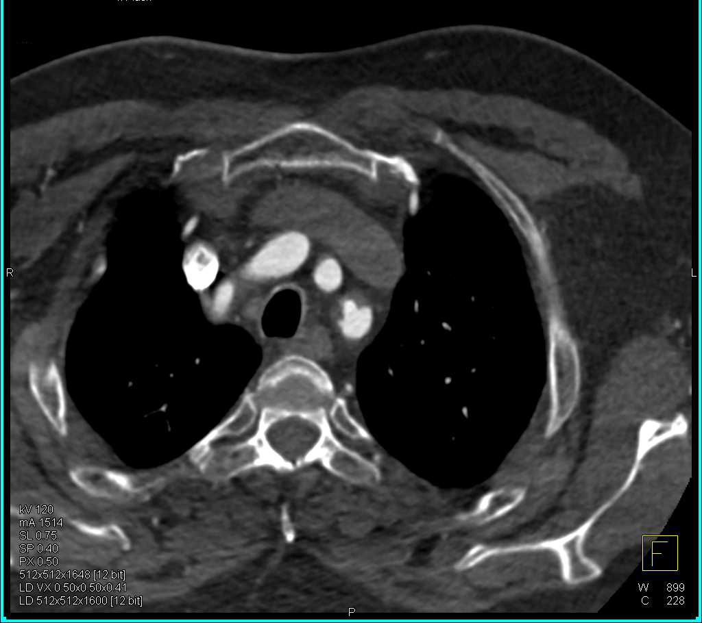 Nice Example of a Left Atrial Appendage - CTisus CT Scan