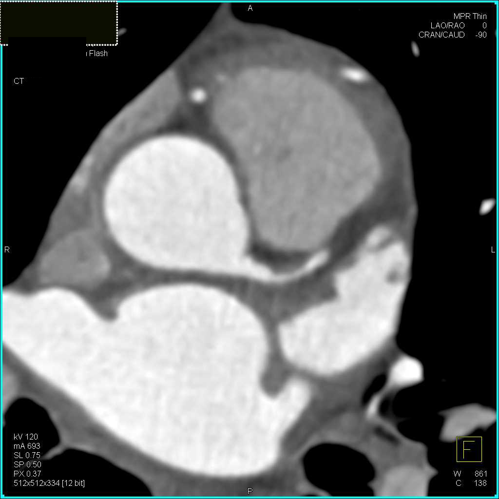 CCTA: Left Anterior Descending Coronary Artery (LAD) Stenosis of Over 50% With Noncalcified Plaque - CTisus CT Scan