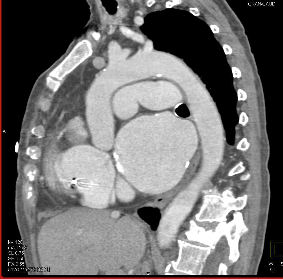 Pseudothrombus in the Left Atrial Appendage - CTisus CT Scan