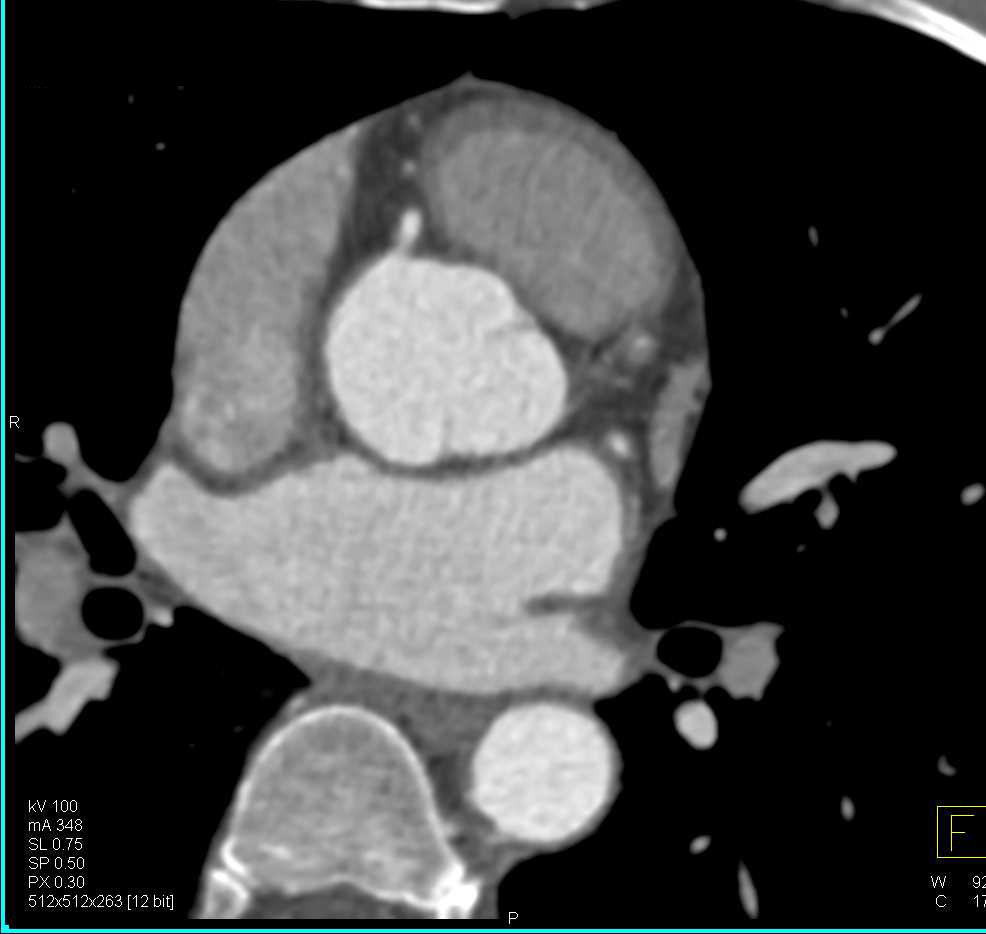 Stenosis: Left Anterior Descending Coronary Artery (LAD) with Critical Stenosis - CTisus CT Scan