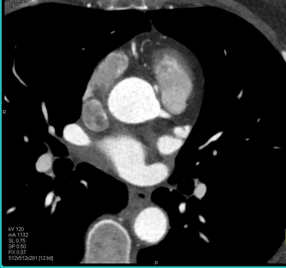 CCTA: Right Coronary Artery Arises off Left Cusp in Malignant Configuration - CTisus CT Scan