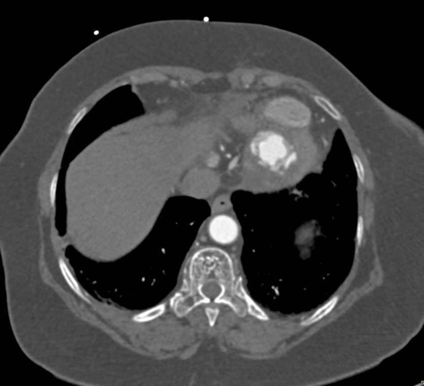 Left Ventricular Aneurysm - CTisus CT Scan