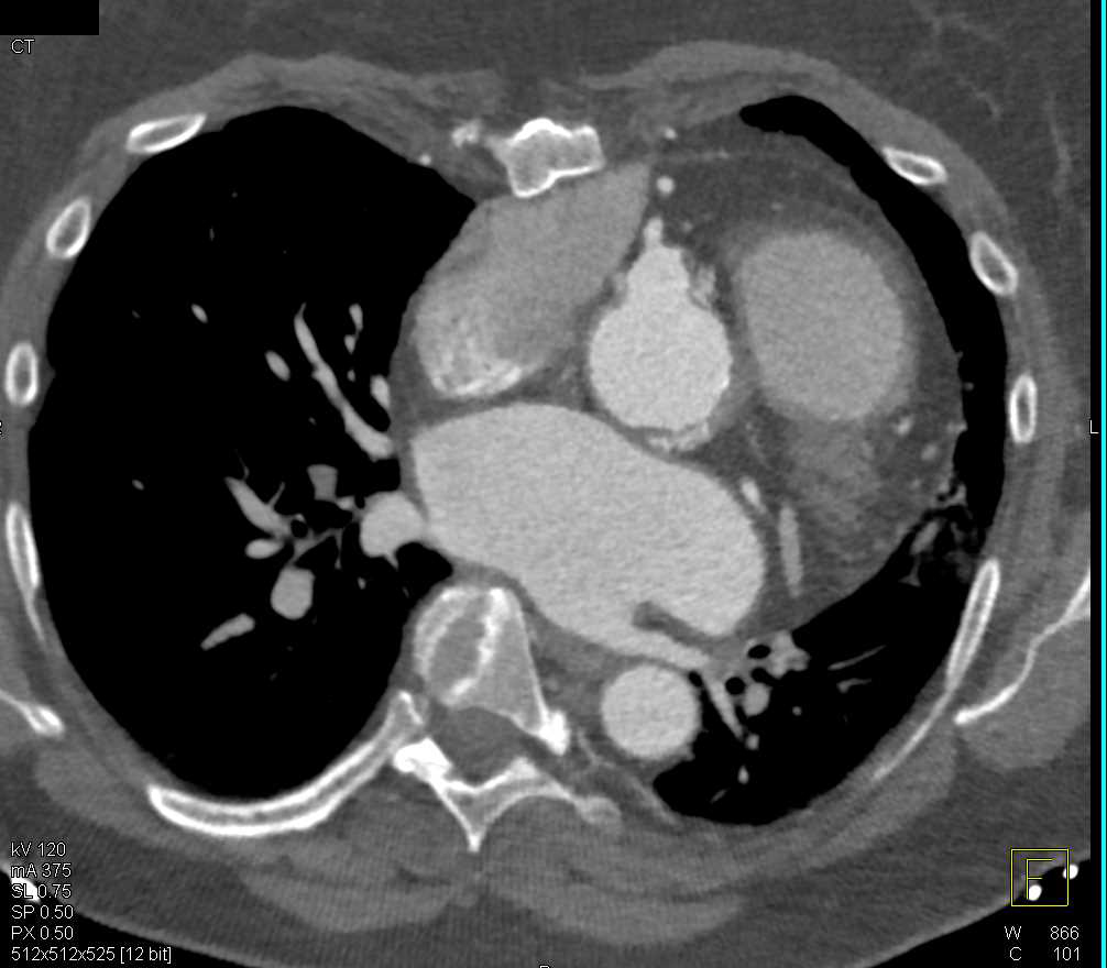 Dilated Origin of Reimplanted Right Coronary Artery (RCA) - CTisus CT Scan