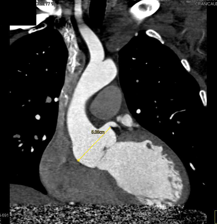 Dilated Sinus of Valsalva in Marfan Syndrome - CTisus CT Scan