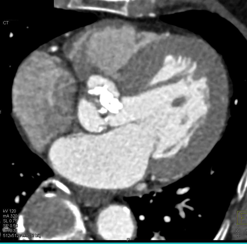 Bicuspid Calcified Aortic Valve with Aortic Stenosis - CTisus CT Scan