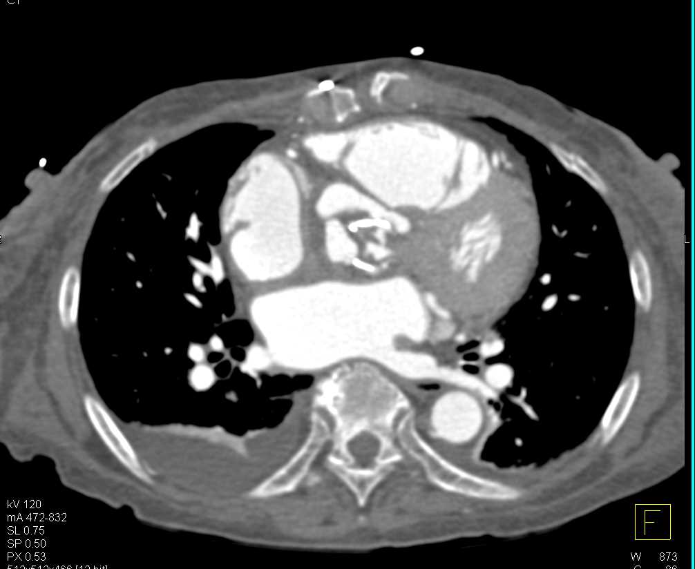 Thrombus in the Aortic Valve - CTisus CT Scan