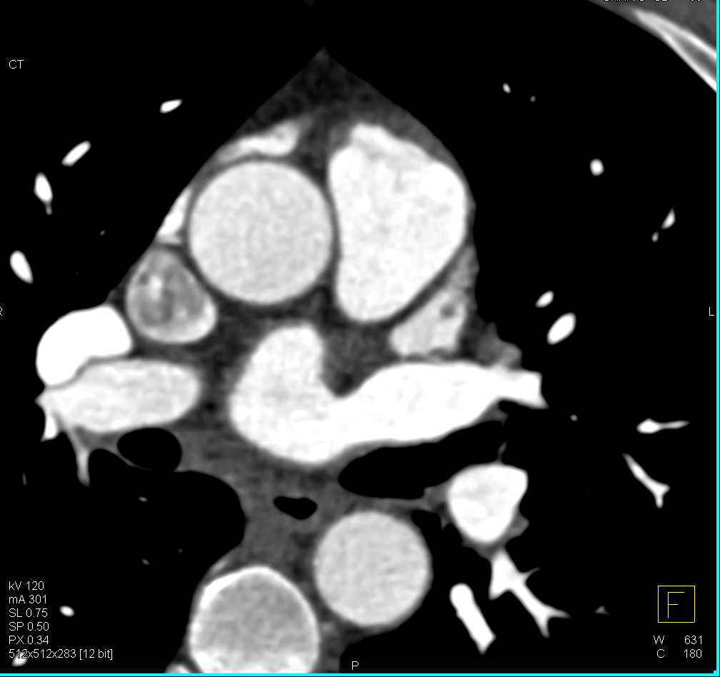 CCTA: Left Anterior Descending Coronary Artery (LAD) Stenosis with Non Calcified Plaque - CTisus CT Scan