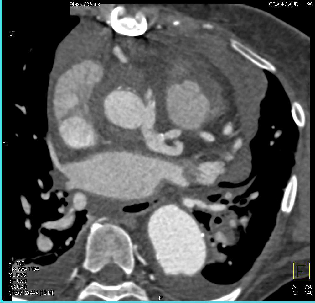 Aortic Root Repair and Type A Dissection - CTisus CT Scan