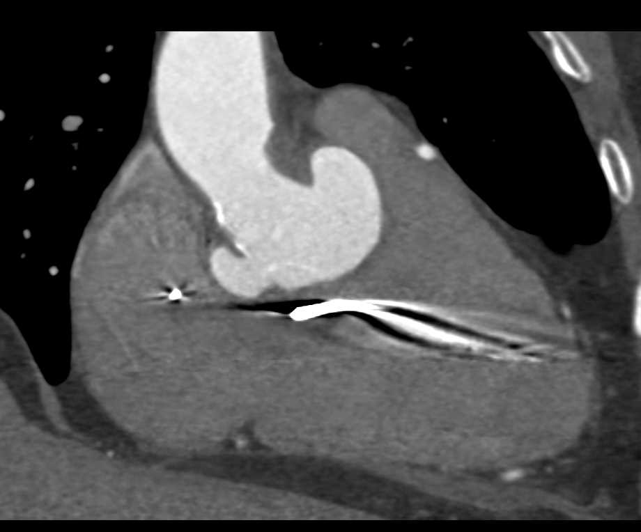 Saccular Dilatation of Sinus of Valsalva Post Aortic Valve Replacement (AVR) - CTisus CT Scan