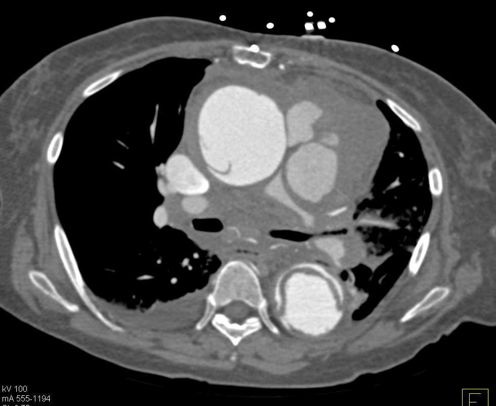 Aortic Dissection with Active Extravasation - Cardiac Case Studies ...