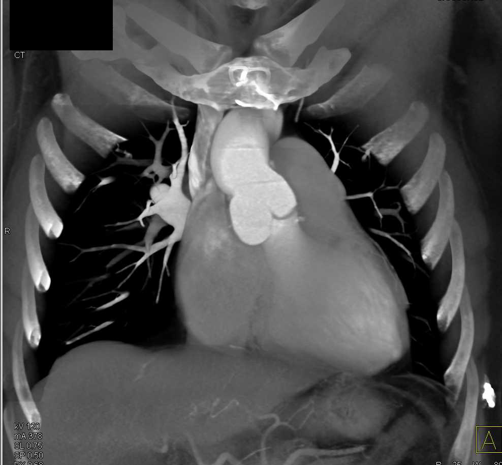 Dilated Sinus of Valsalva in Marfan Syndrome - CTisus CT Scan