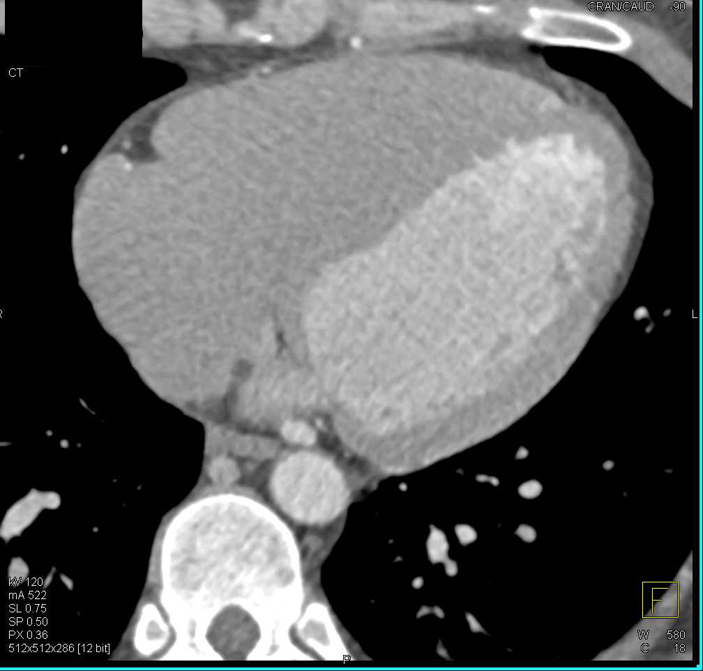 CCTA with Myocardial Bridging - CTisus CT Scan