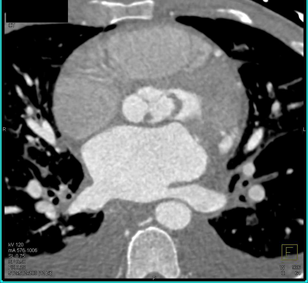 Disease Aortic Valve with Clot Simulating a Mass - CTisus CT Scan