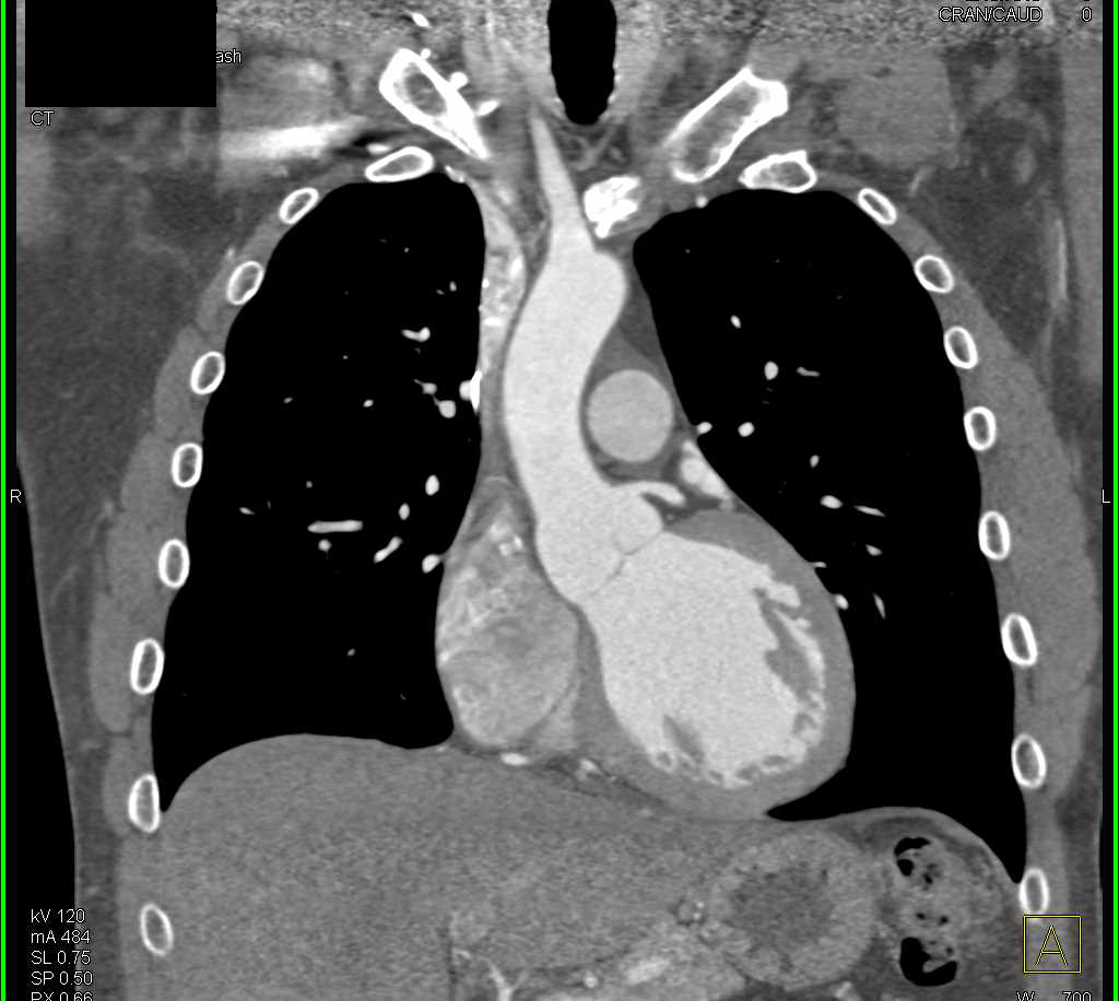 Deformed Aortic Valve with Thickened Leafs of Aortic Valve - CTisus CT Scan