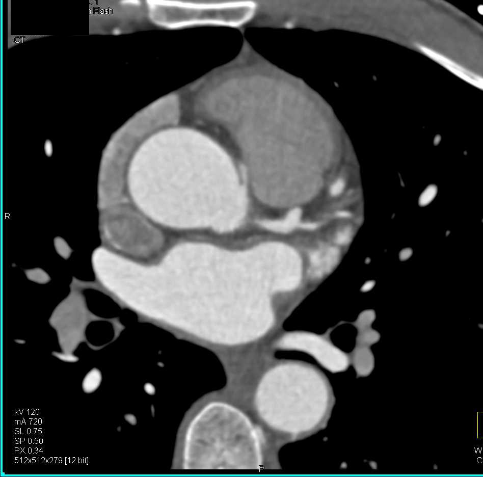 CCTA: Right Coronary Artery Arises off Left Cusp in Malignant Configuration - CTisus CT Scan