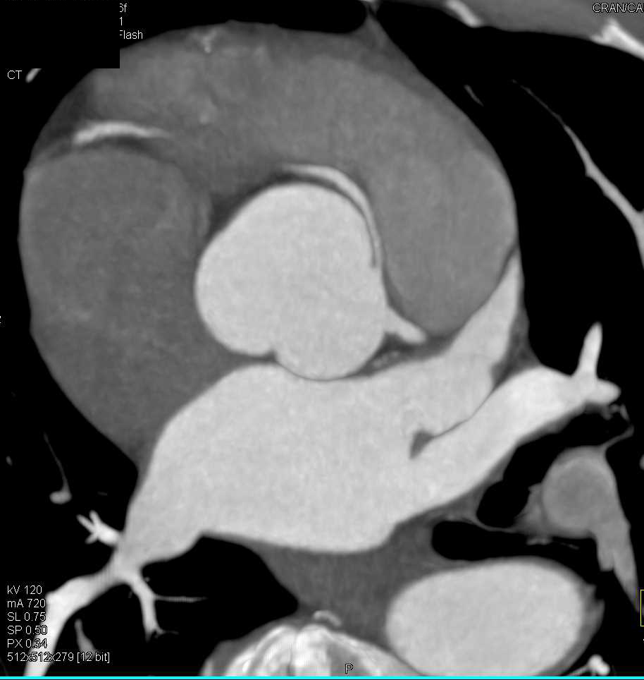 CCTA: Right Coronary Artery Arises off Left Cusp in Malignant Configuration - CTisus CT Scan