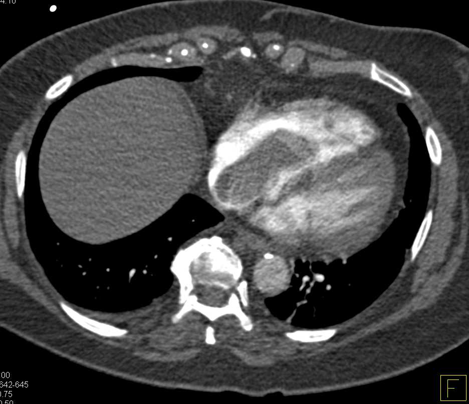 Large Thrombus in the Right Atrium - CTisus CT Scan