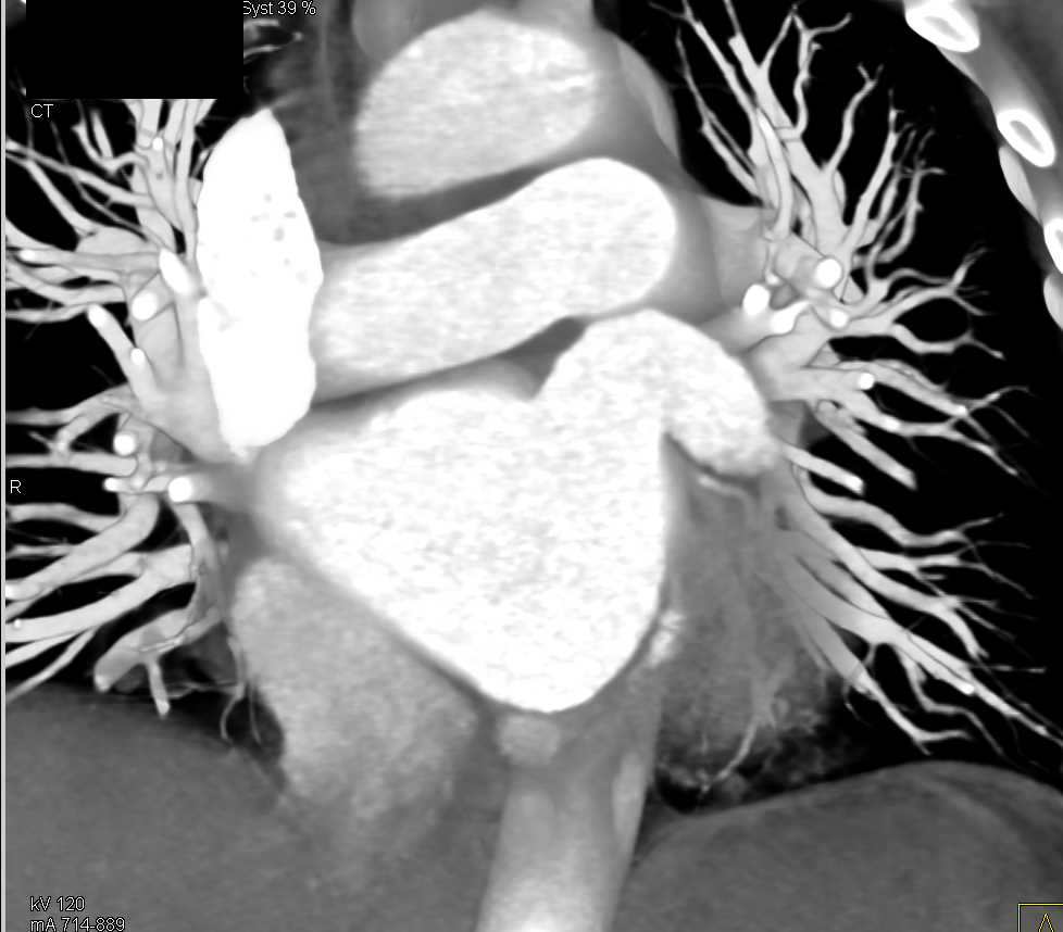 Aortic Valve Replacement Without Complication - CTisus CT Scan