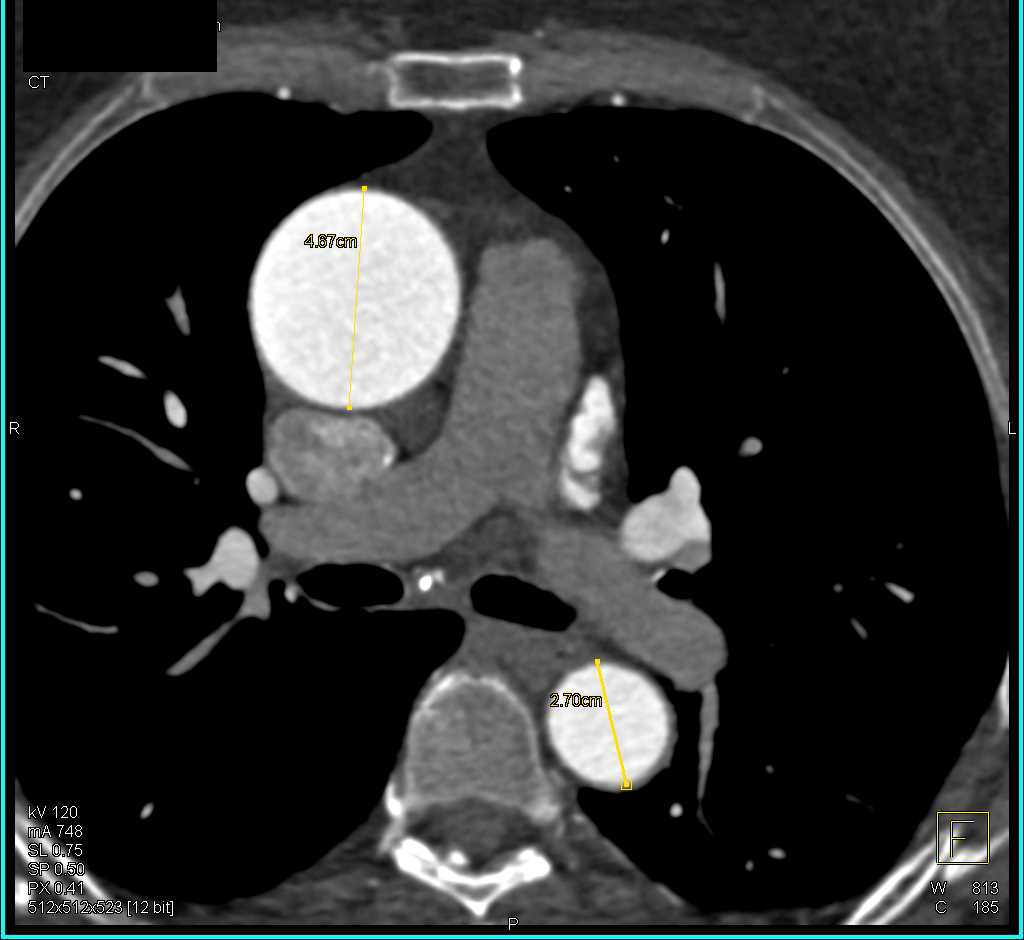 Dilated Ascending Aorta with Normal Aortic Valve Leaflets - CTisus CT Scan