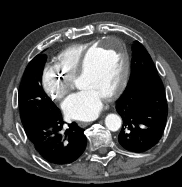 Infarct Left Ventricle with Thrombus - CTisus CT Scan