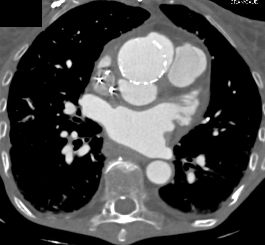 Pseudoaneurysm of the Aortic Root Following Aortic Valve Replacement (AVR) - CTisus CT Scan