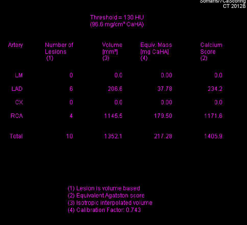 Agatston Score of 1406 with Corresponding Coronary CTA - CTisus CT Scan