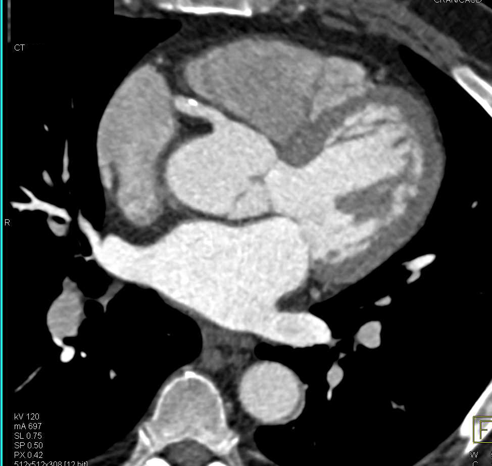 CCTA: Multivessel Disease with Left Anterior Descending Coronary Artery (LAD) and Right Coronary Artery (RCA) Mixed Plaque - CTisus CT Scan