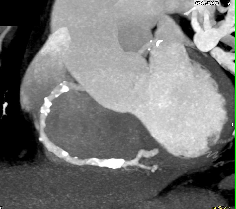 CCTA: Multivessel Disease with Left Anterior Descending Coronary Artery (LAD) and Right Coronary Artery (RCA) Mixed Plaque - CTisus CT Scan