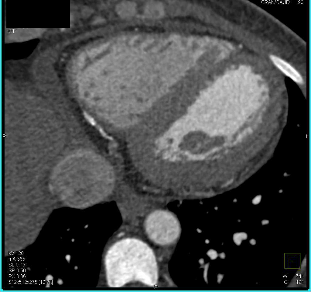 CCTA: Agatston Score of 2011 with Corresponding CTA - CTisus CT Scan