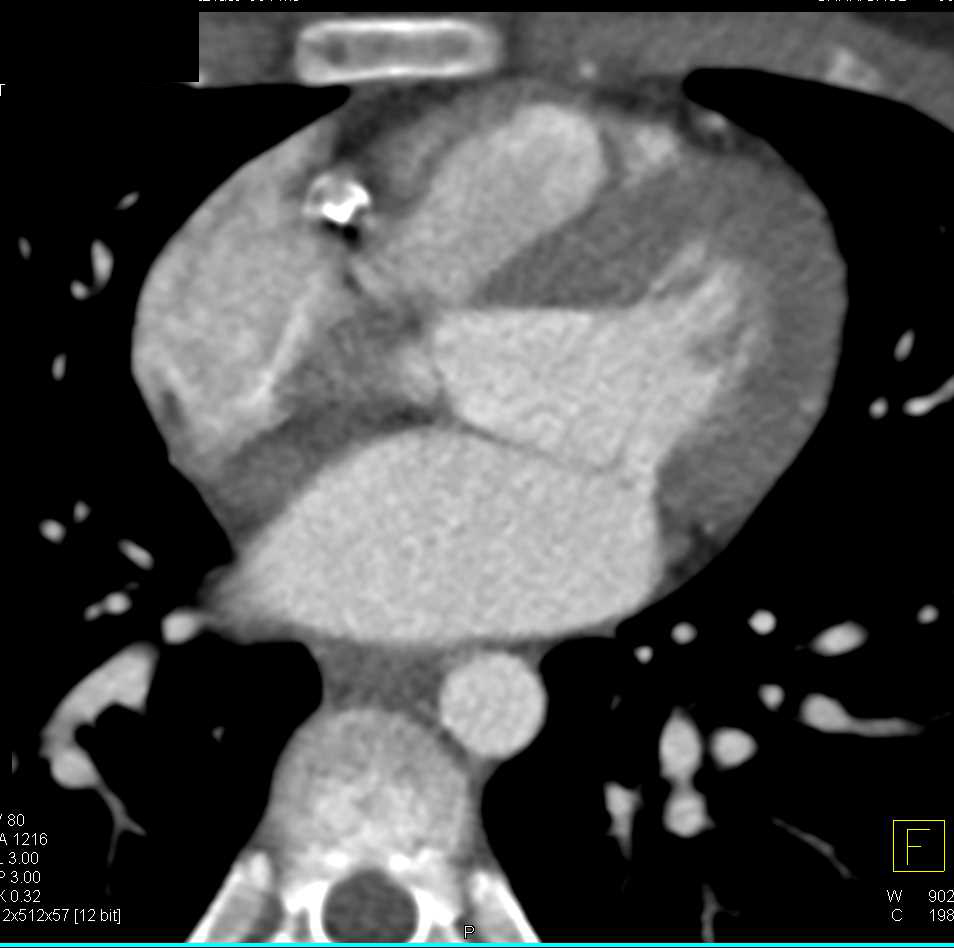 CCTA: Right Coronary Artery Disease - CTisus CT Scan