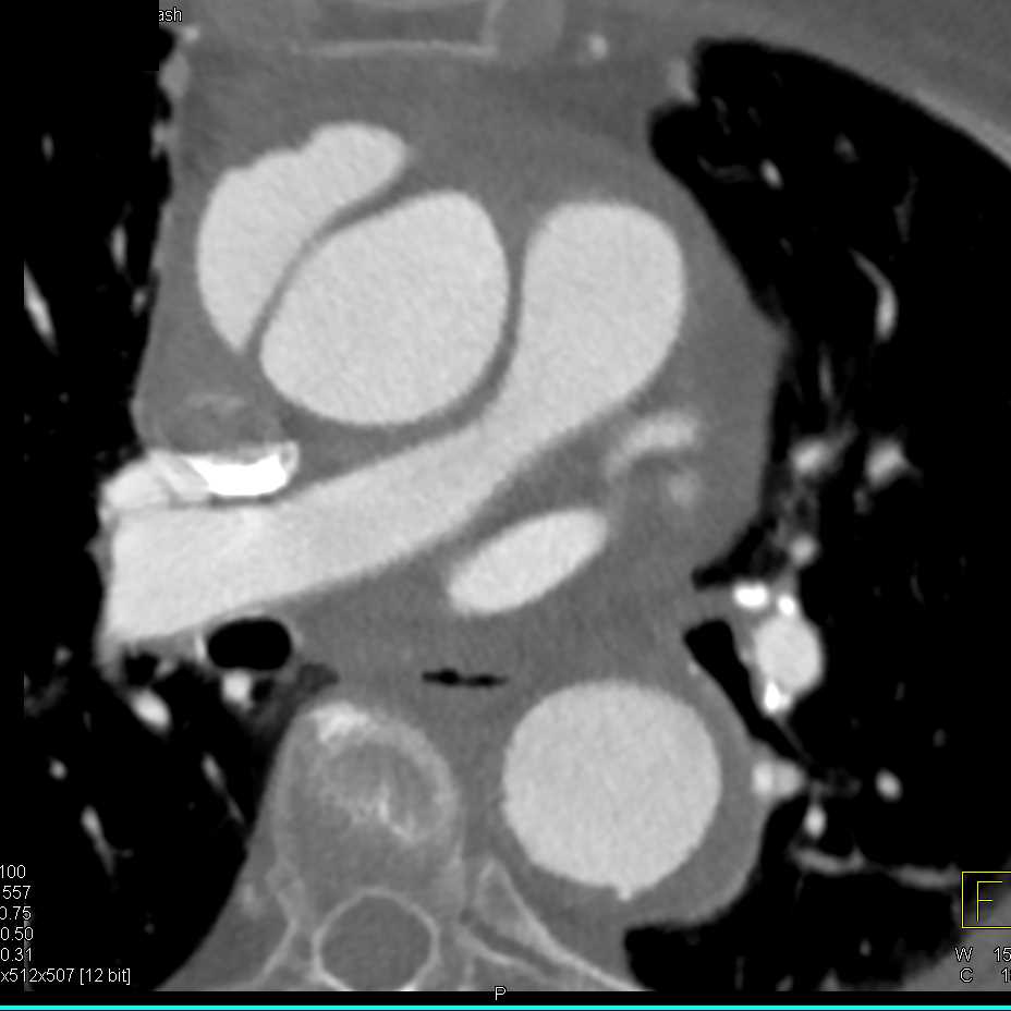 Ulcerating Plaque in Ascending Aorta - CTisus CT Scan