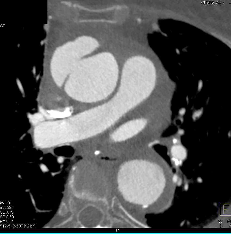 Ulcerating Plaque in Ascending Aorta and Pericardial Effusion - CTisus CT Scan