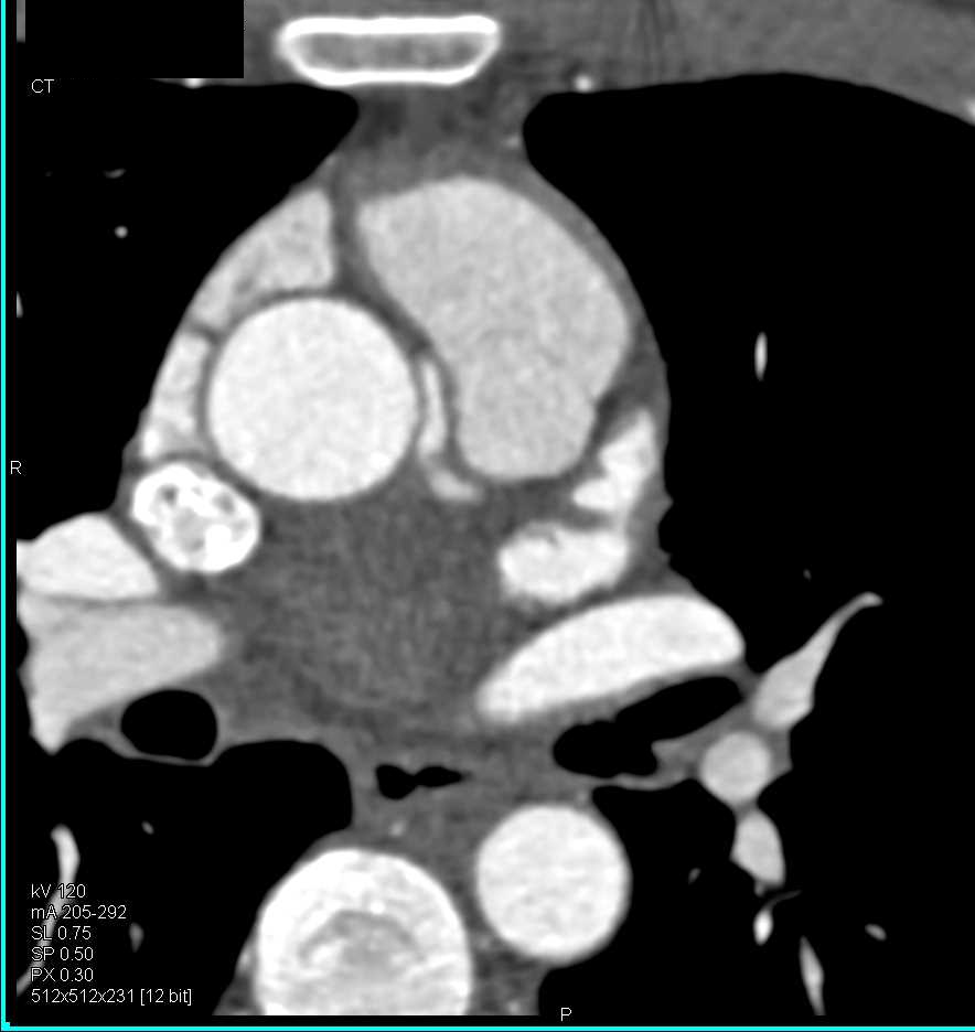 CCTA: Right Coronary Artery Arises off Left Cusp in Malignant Configuration - CTisus CT Scan