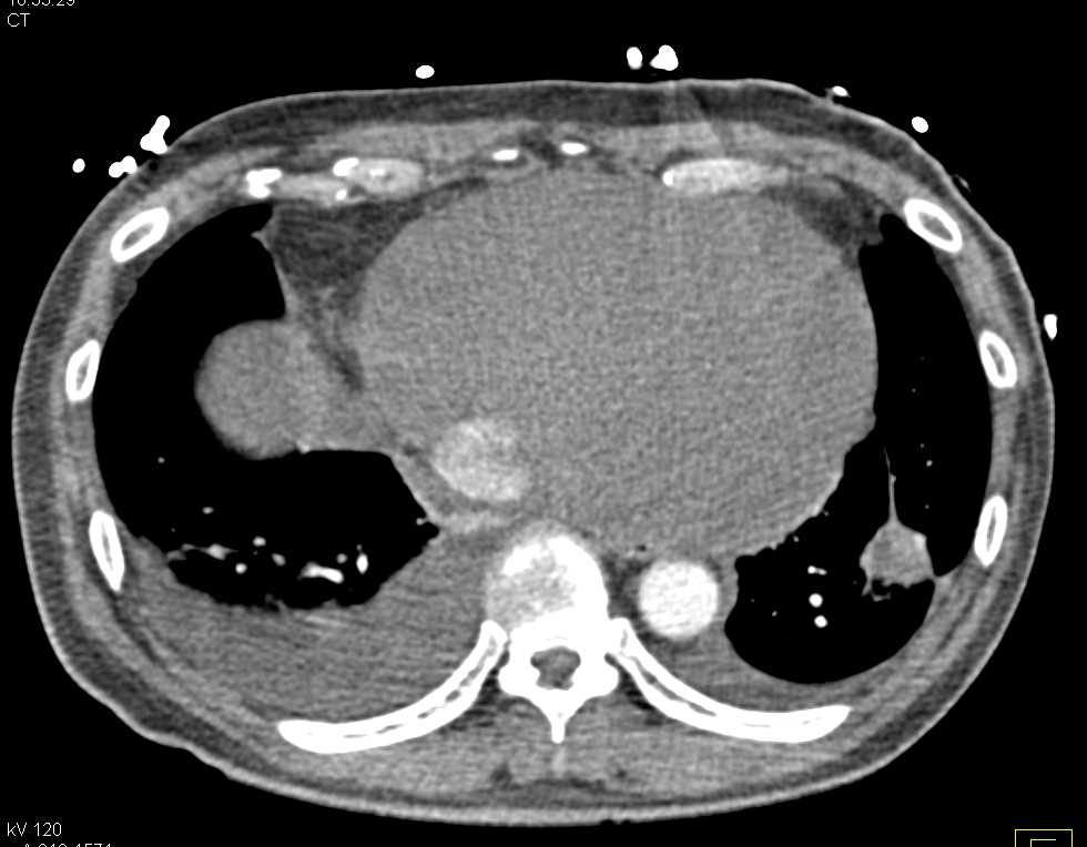 Large Pericardial Effusion - CTisus CT Scan