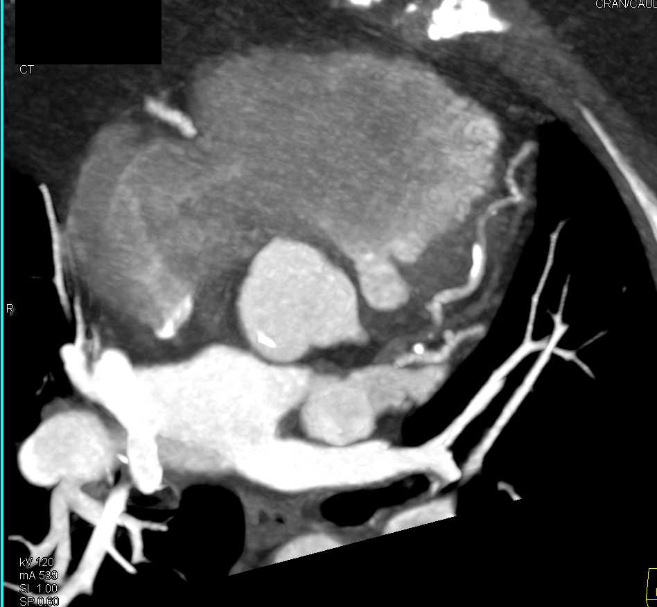 CCTA: Left Anterior Descending Coronary Artery (LAD) Stenosis with Non Calcified Plaque and Calcified Plaque - CTisus CT Scan