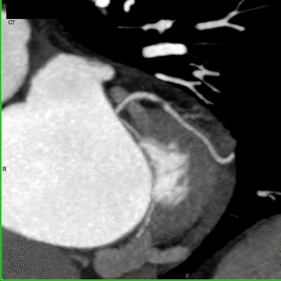 CCTA: Critical Stenosis in Left Anterior Descending Coronary Artery (LAD) - CTisus CT Scan