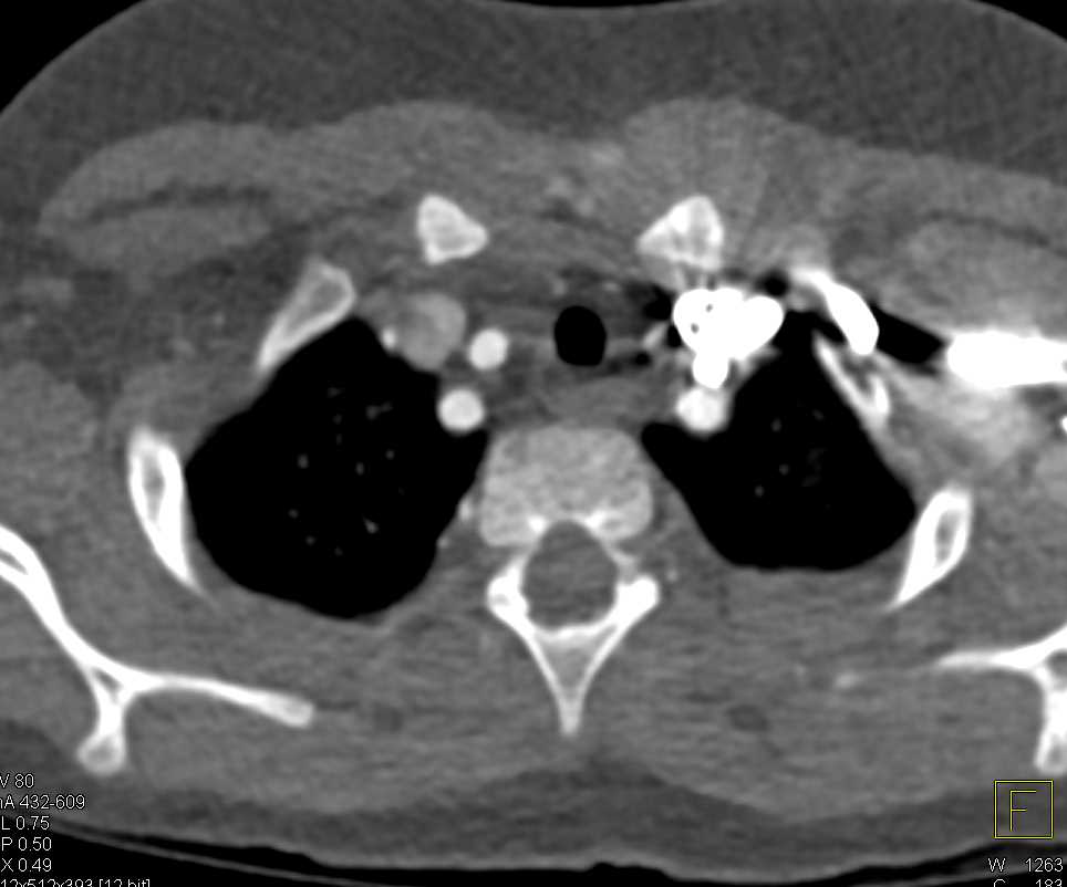 Right Aortic Arch with a Near Ring Configuration - CTisus CT Scan