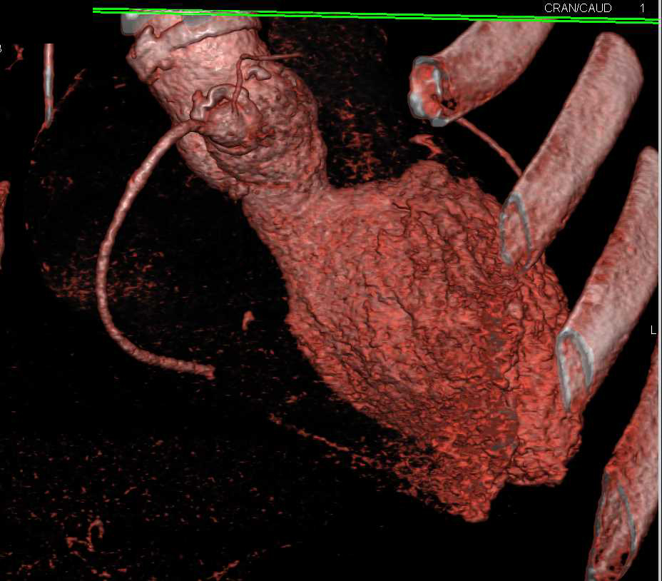 Re-implanted Right Coronary Artery - CTisus CT Scan