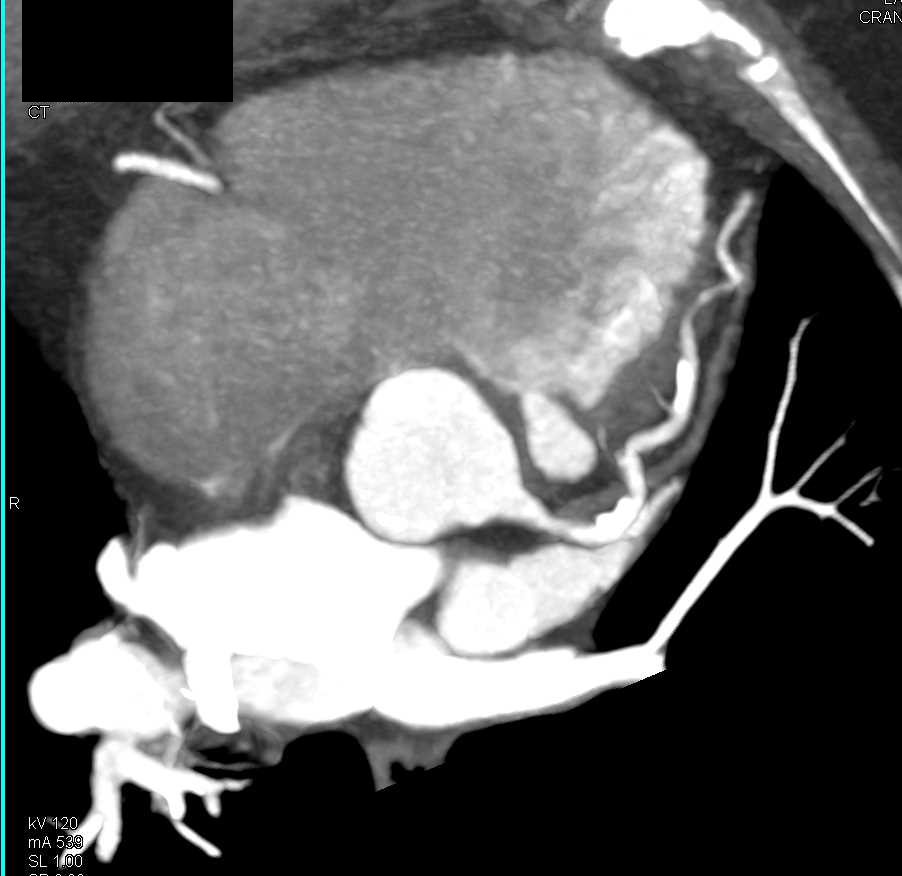 CCTA with Extensive Plaque Left Anterior Descending Coronary Artery (LAD) - CTisus CT Scan