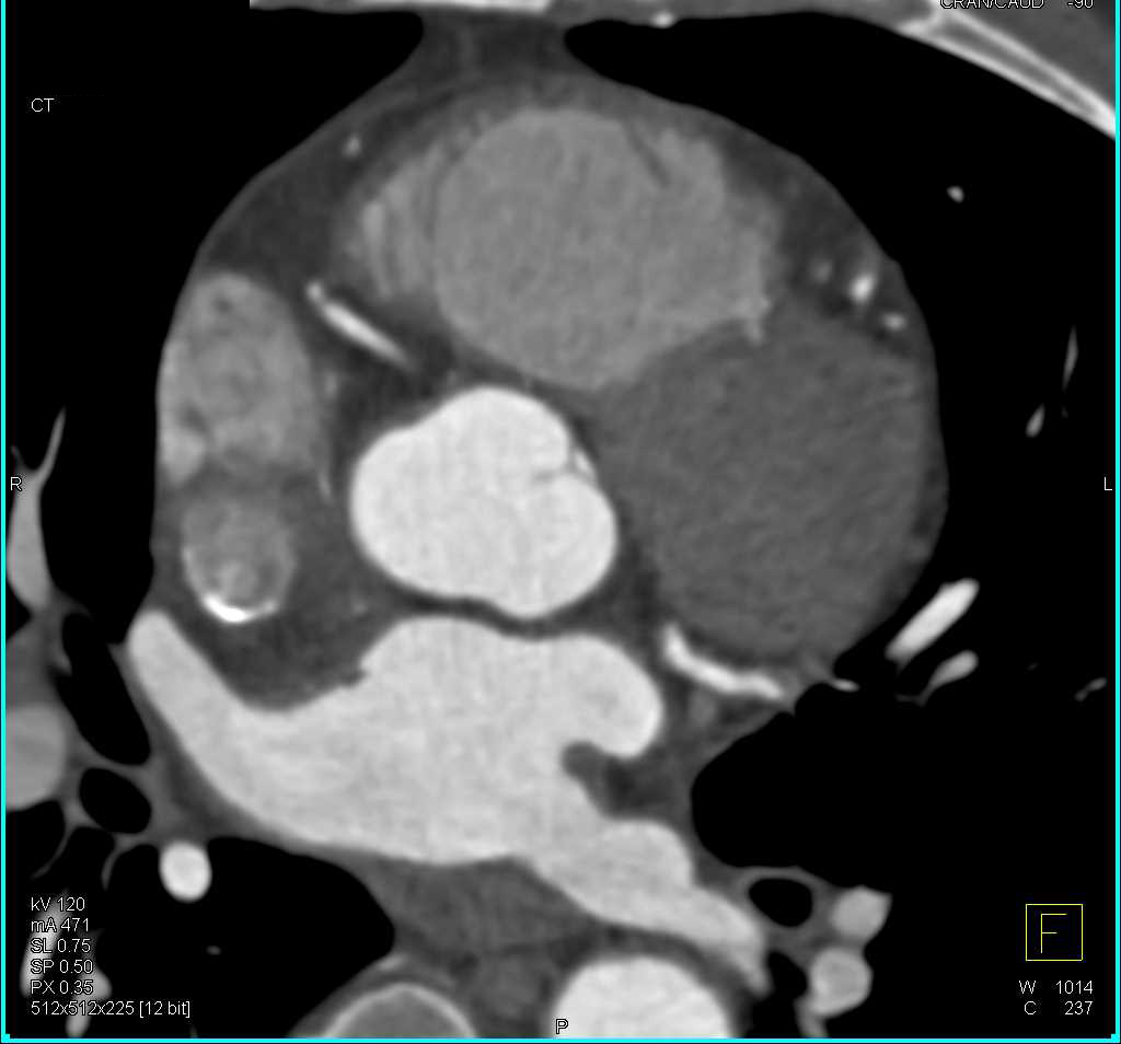 CCTA: Left Anterior Descending Coronary Artery (LAD) Stenosis with Non Calcified Plaque - CTisus CT Scan