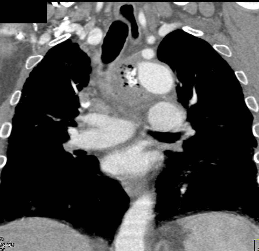 Pseudoaneurysm Aortic Root with Contrast Extravasation - CTisus CT Scan